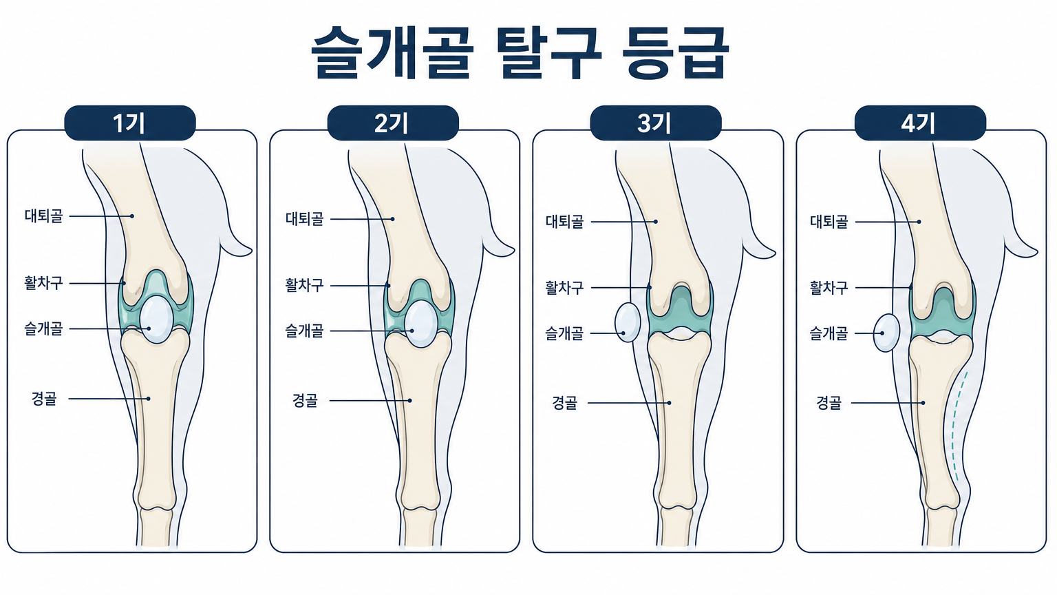 슬개골 탈구 1기부터 4기까지의 무릎뼈 위치 (등급 정의는 PMC 2024 리뷰 수록 분류표 기준, 자체 제작 도식)
