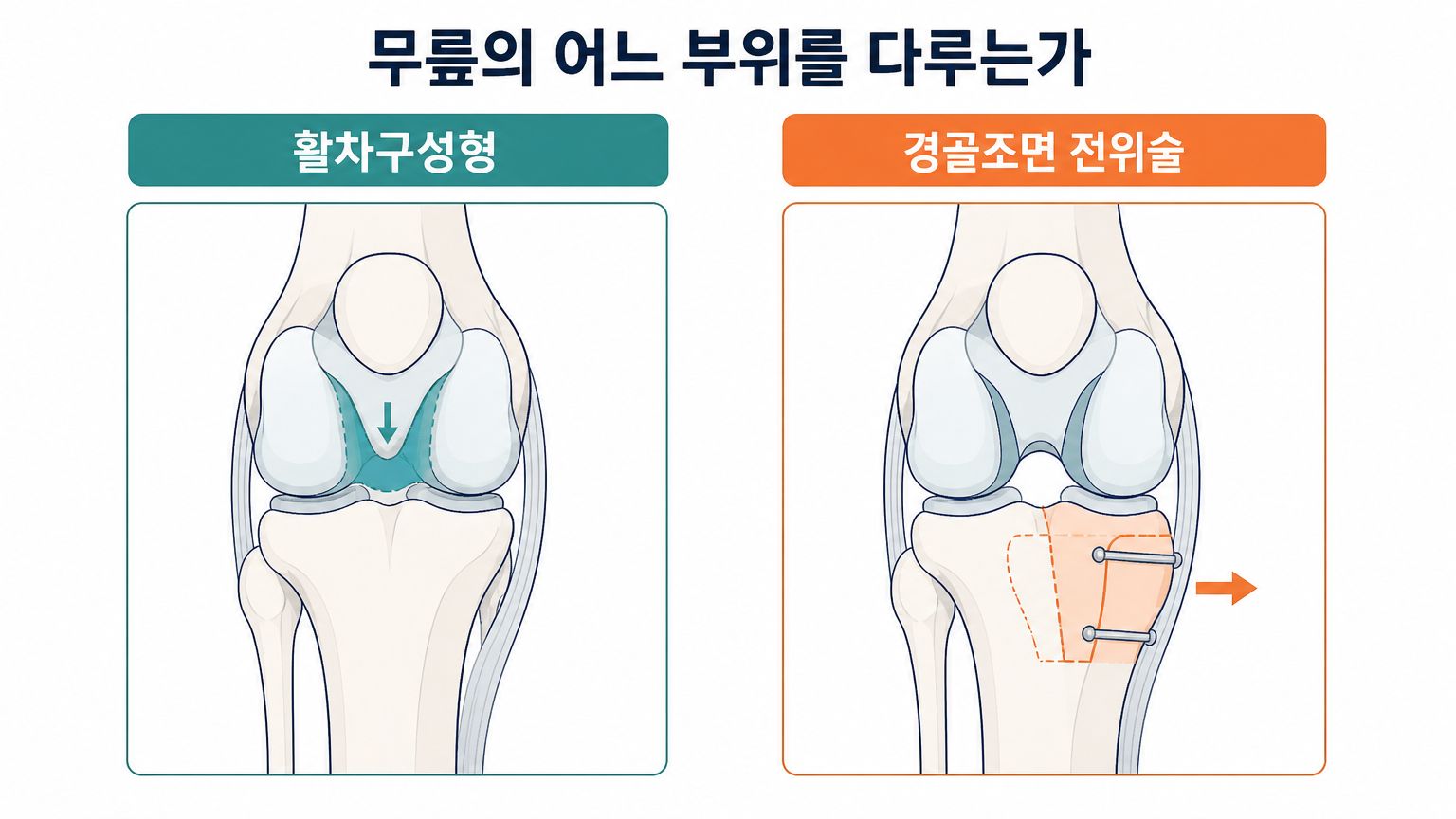 활차구성형과 경골조면 전위술이 다루는 부위 (MSD 수의 매뉴얼 기준, 자체 제작 도식)