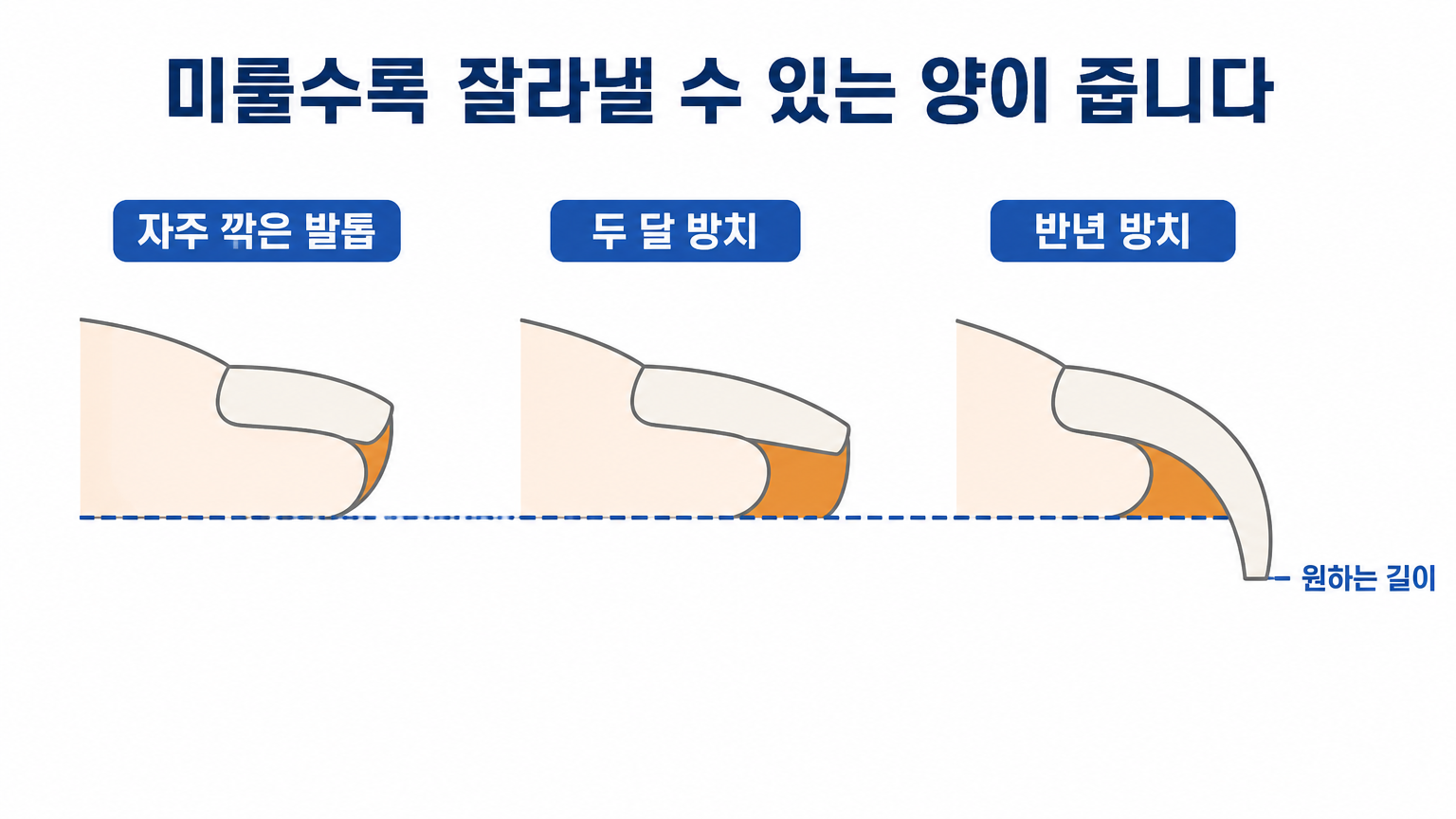 방치 기간이 늘어날 때 발톱 길이와 혈관 끝이 함께 내려오는 변화 (댕묘 작성)