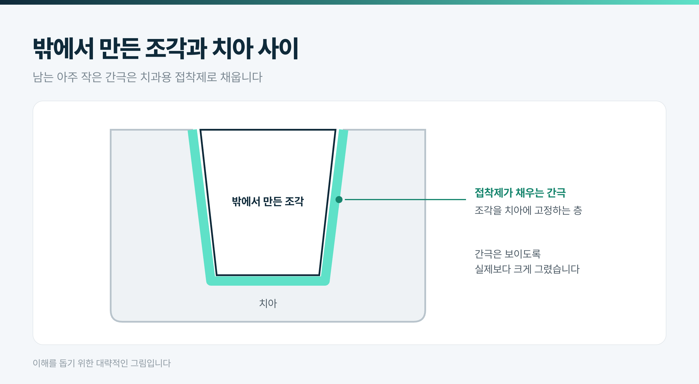 밖에서 만든 조각과 치아 사이 · 이해를 돕기 위한 대략적인 그림입니다