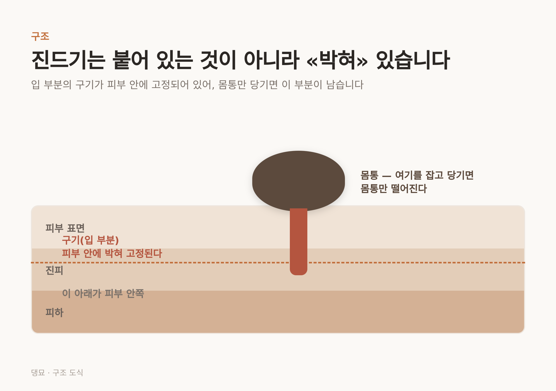 진드기는 구기를 피부 안에 박아 고정한다 — 몸통만 당기면 이 부분이 남는다